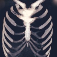 В клинике Страдиня прошла уникальная операция по замене грудной кости c использованием 3D-технологии