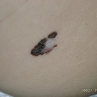 Bīstami pieaug saslimstība ar ādas vēzi melanomu