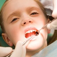 800 bērnu rindā uz zobu labošanu vispārējā anestēzijā. Cik tā nepieciešama?