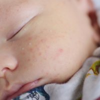Zīdaiņu ādas problēmas – kas ir jaundzimušo akne un toksiskā eritēma