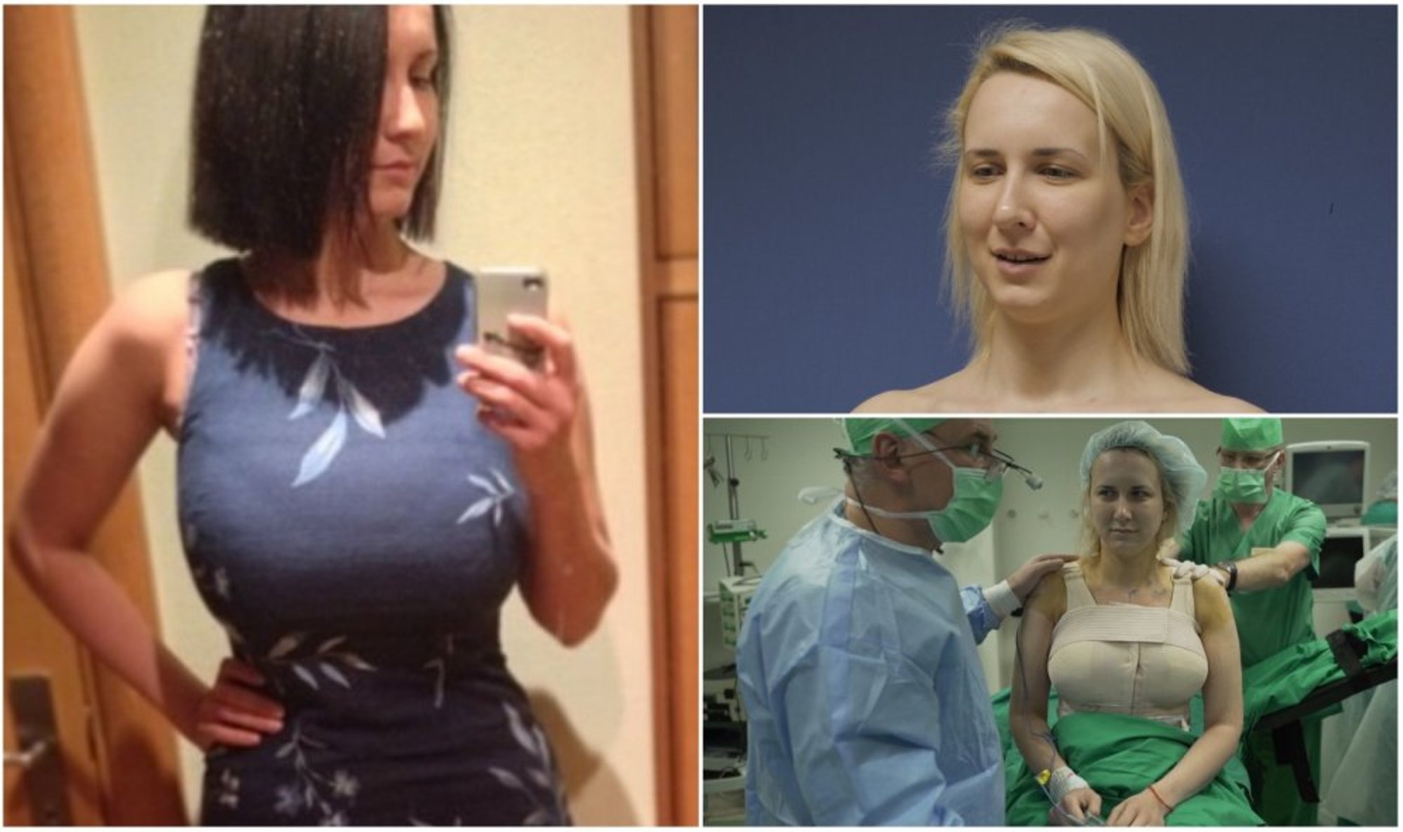 как проходит операция по уменьшению груди у женщин фото 47