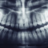 Skaists smaids uz desmit gadiem: vai savu zobu zaudēšana ir tā vērta